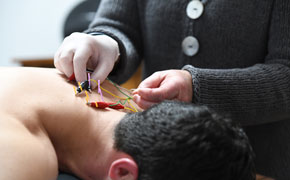 dry needling